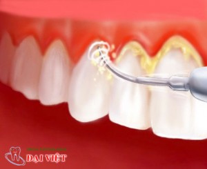 Mảng bám dính lâu ngày tại răng tạo thành cao răng