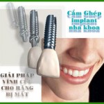 implant nha khoa giải pháp cho răng bị mất