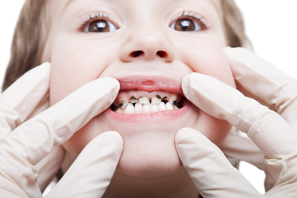 Chăm sóc răng miệng tránh sâu răng