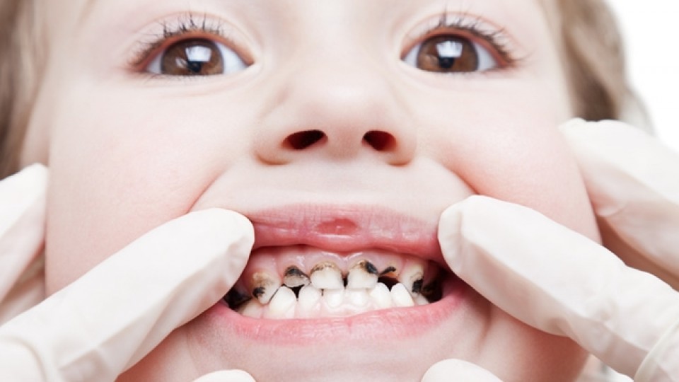 Sâu răng ở trẻ