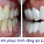 công nghệ Răng sứ Lava Plus Trước và sau điều trị