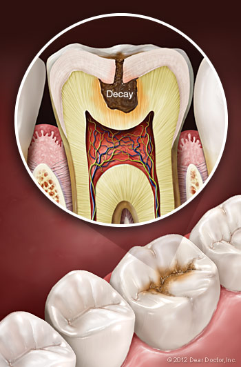 Sâu răng ảnh minh họa nguồn pinterest