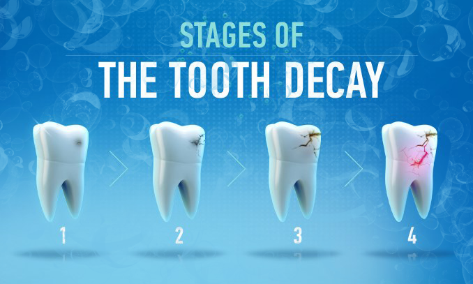 Các giai đoạn sâu răng