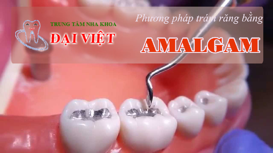 Phương pháp trám răng bằng amalgam
