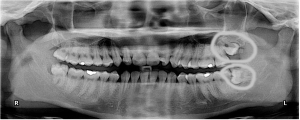 Ngay khi phát hiện bị mọc lệch răng 8 bạn nên tính đến việc đi nha sỹ để xin lời khuyên có nên tiếp tục duy trì chiếc răng này hay không.