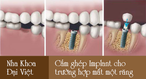 Cắm ghép implant cho trường hợp mất răng cửa
