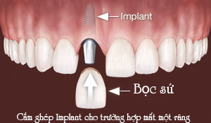 Hình ảnh minh họa cắm ghép implant 1 răng