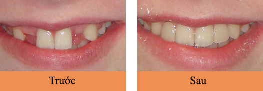 Hình ảnh làm cầu răng trước và sau