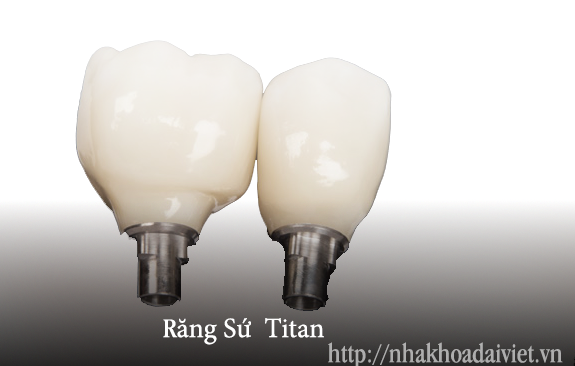 Hình ảnh răng sứ titan