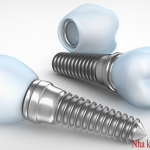 Hình ảnh Răng sứ implant