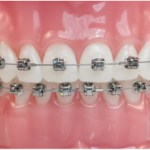 Hình ảnh mô phỏng niềng răng kim loại