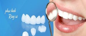 Bọc răng sứ giữ được bao lâu – Nha Khoa Đại Việt