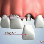 Răng sứ implant